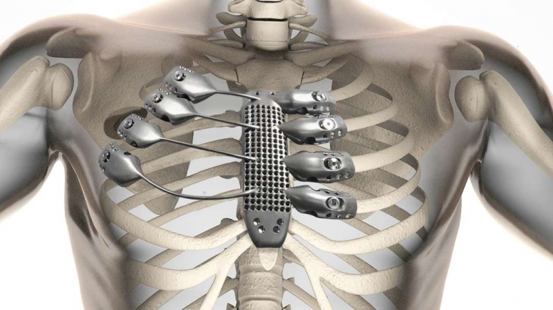 3D printing for medical industry, 3D printed sternum by Anatomics