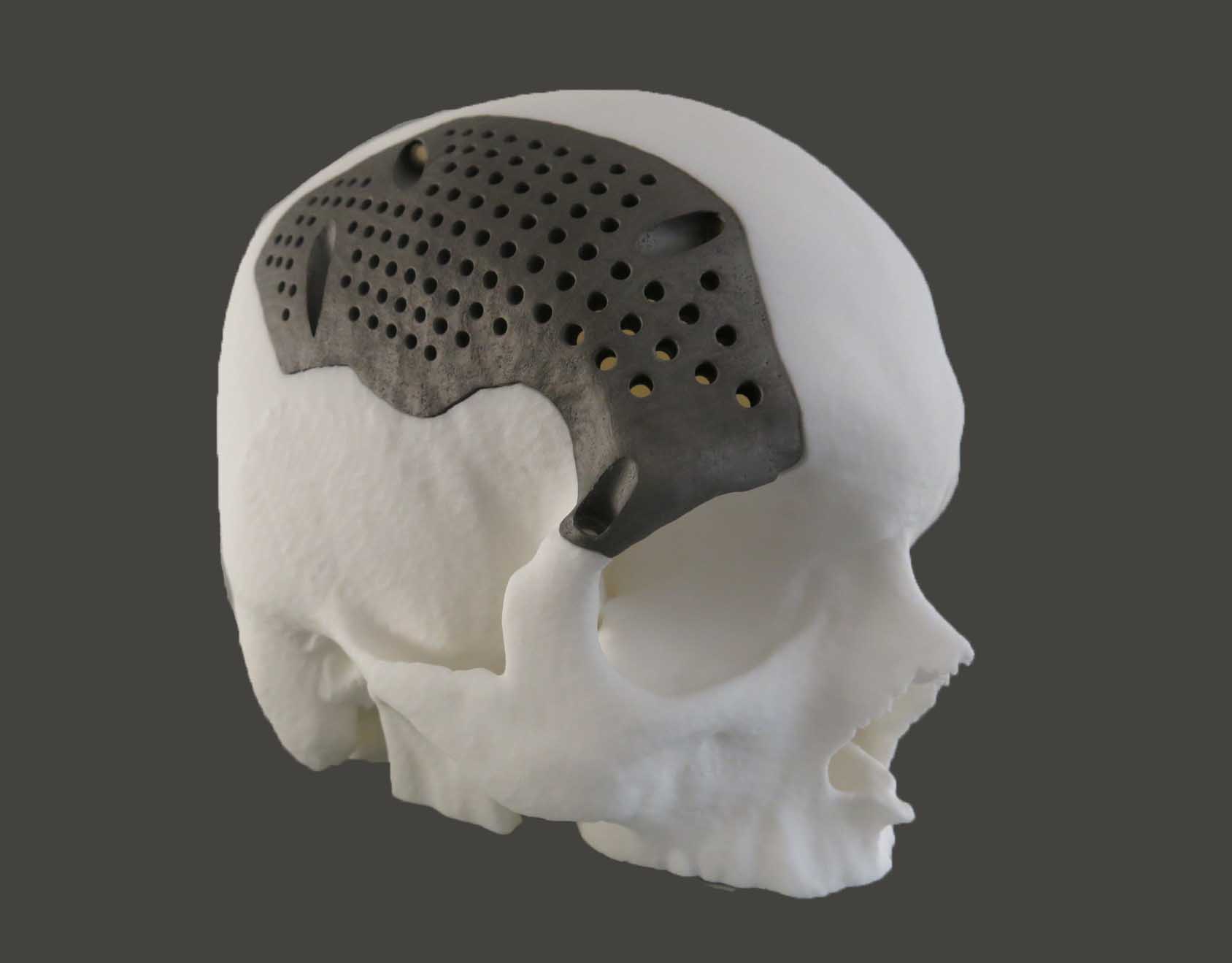 3D Printed titanium-medical-implants-sculpteo