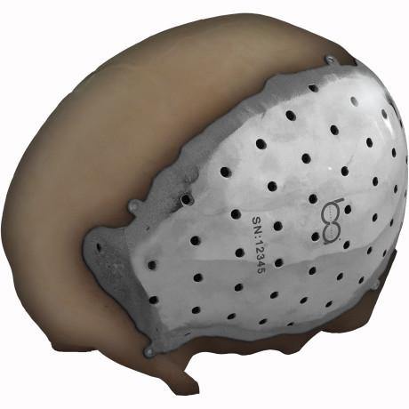 3D printing cranial reconstruction