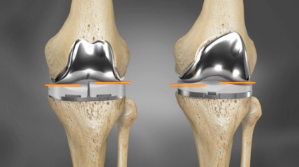 https://www.healthtechevent.com/health-care/global-knee-implant-market-revolutionised-conformis-3d-printed-knee-replacements/