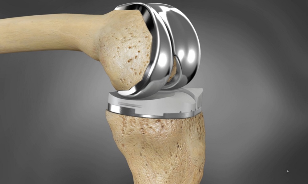 The 3D printed knee replacement