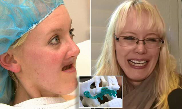 https://www.dailymail.co.uk/news/article-6453939/Woman-31-lost-jaw-teeth-cancer-fitted-3D-jaw-world-makeover.html