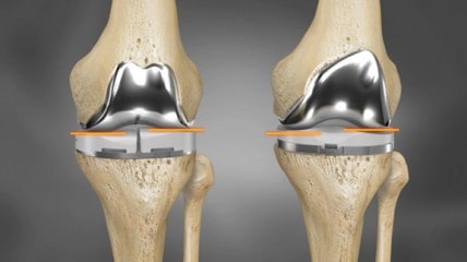3D printed knee